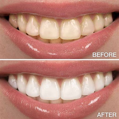 bright now teeth whitening|Book a Dentist Appointment Near You Online at a。